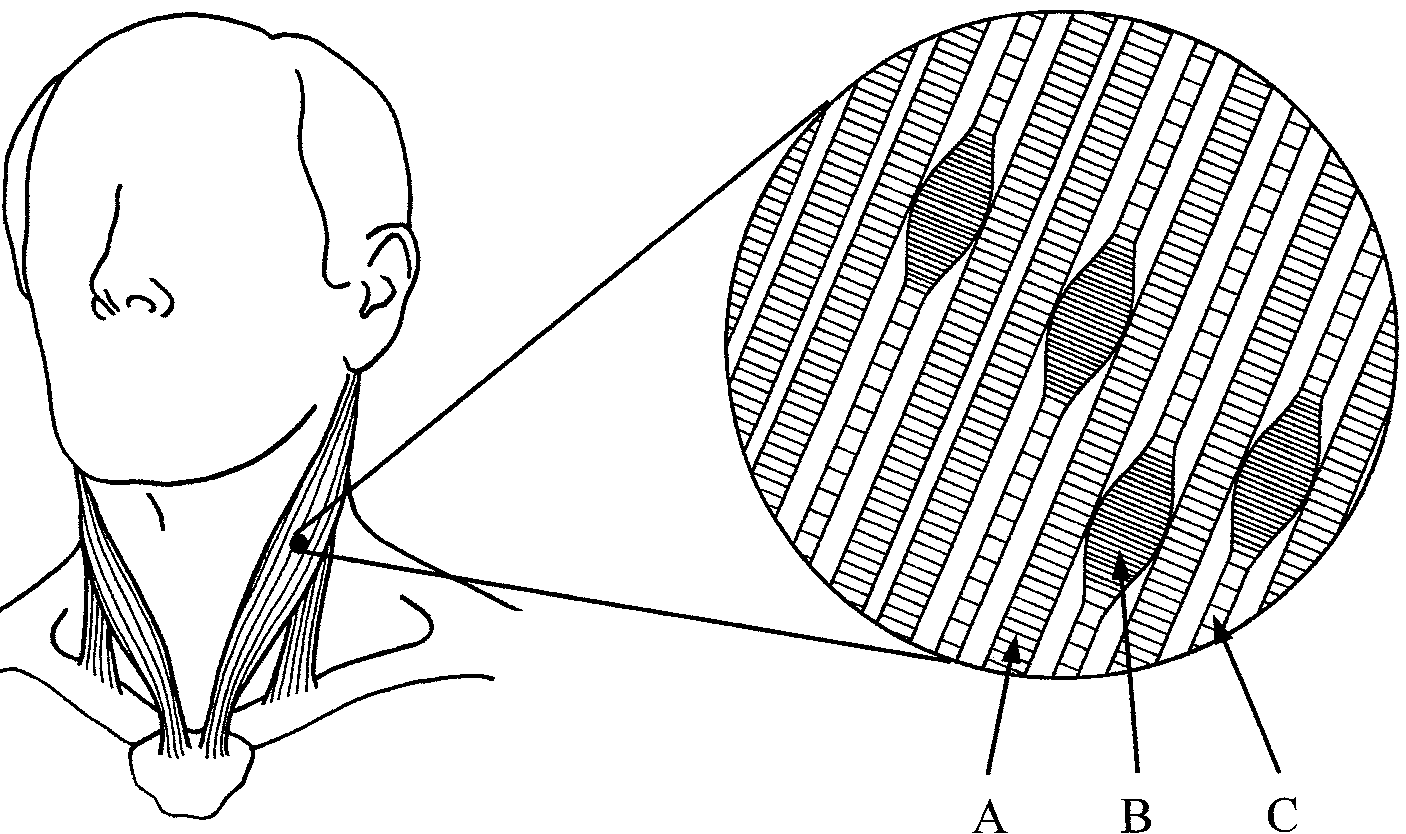 Muscle Trigger Point